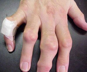 пальці з деформацією суглобів викликають біль