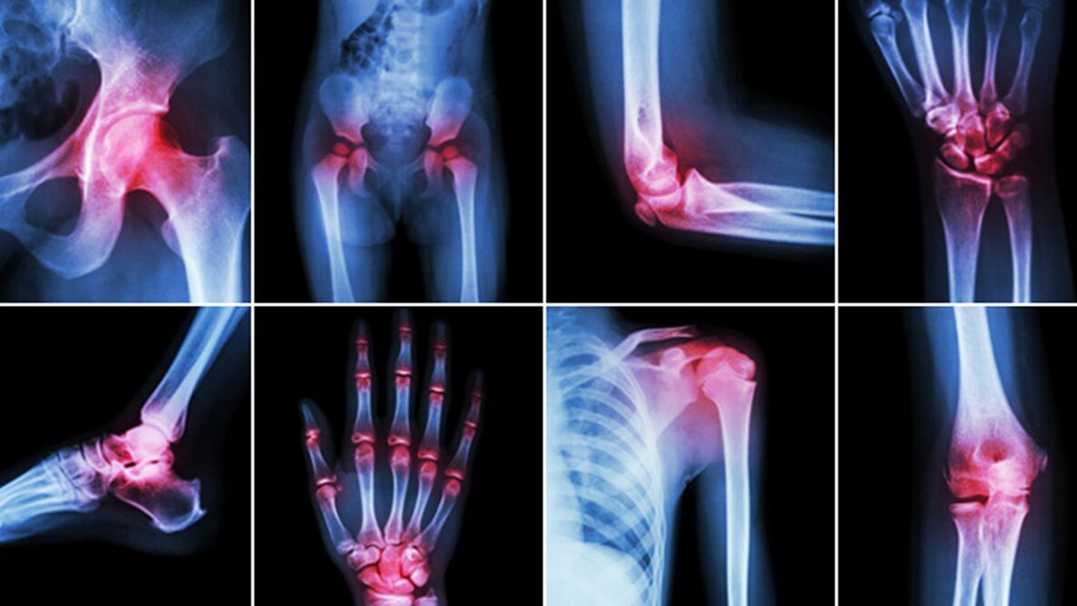 рентгенівські знімки при болях в суглобах