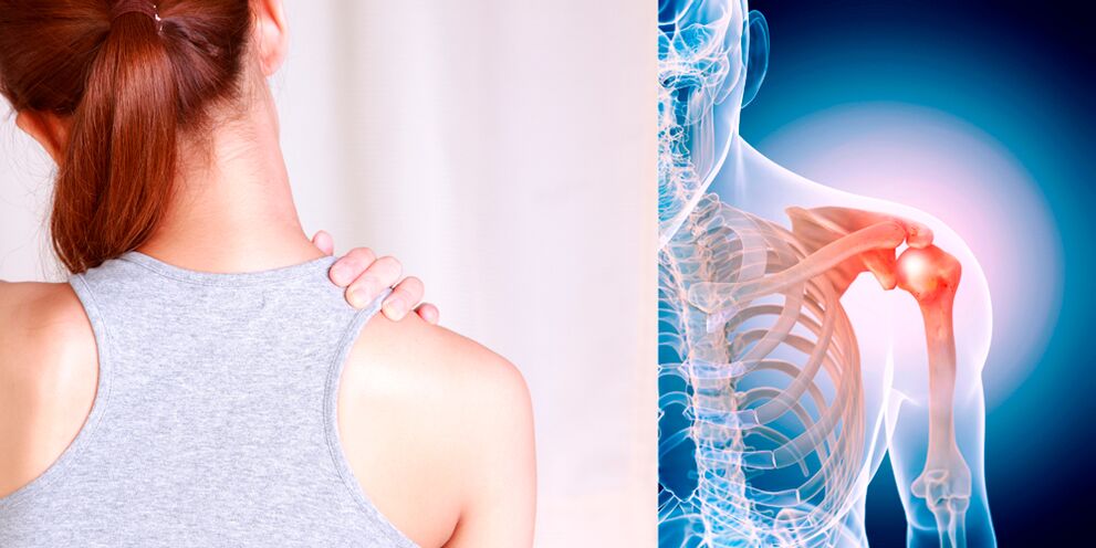 Розвиток артрозу плеча поступово призводить до постійних болів