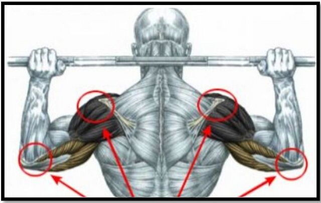 Навантаження на м'язи плеча та ліктя – одна з причин артрозу плечового суглоба. 